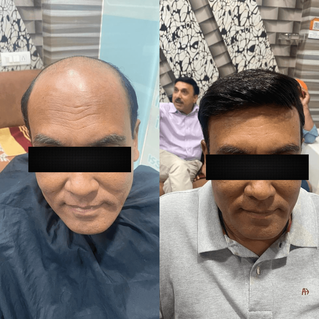 hair treatment in vadodara